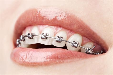 Orthodontie.